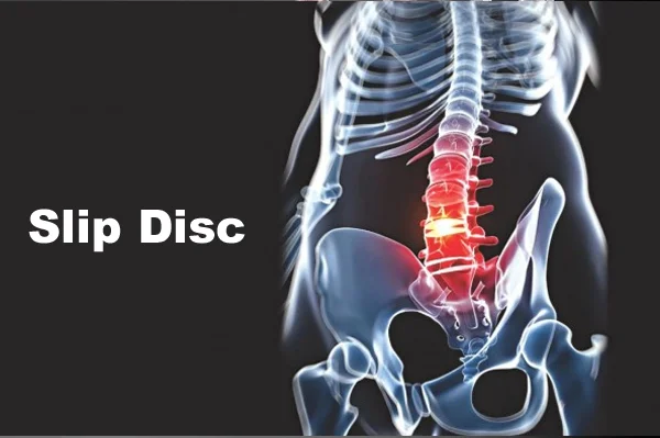 Disc Problem