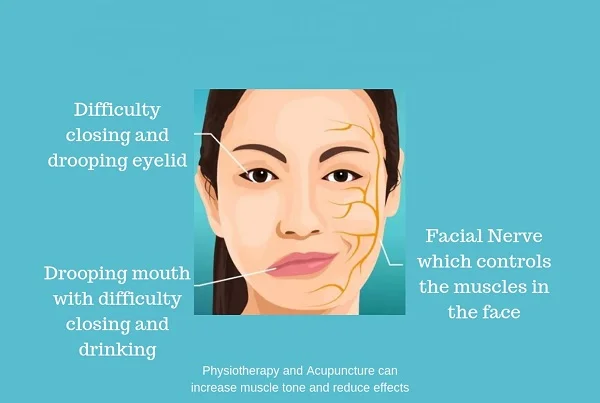Facial Palsy