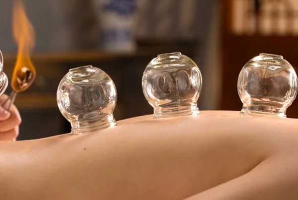 Cupping Therapy